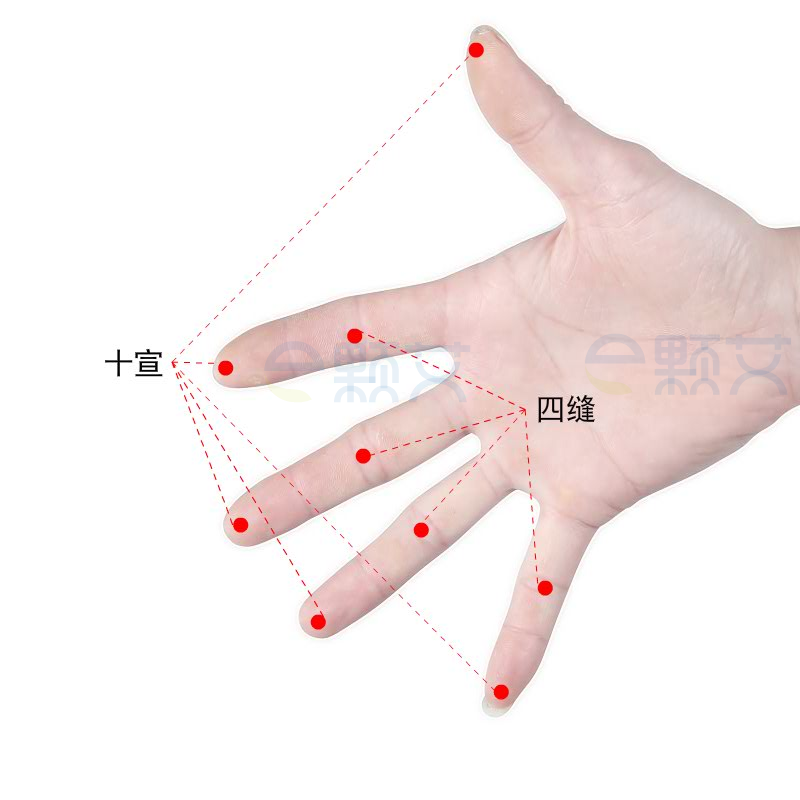 十宣穴位图 艾灸取穴方法 主治病症 应用经验