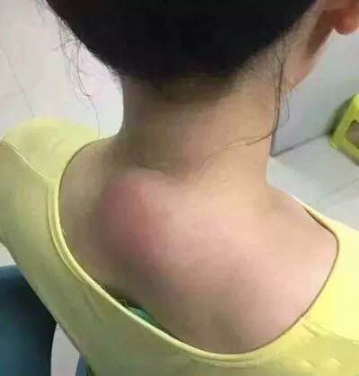脖子上的大包是怎么回事 e颗艾养生